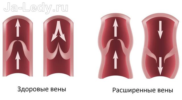 Вены на ногах лечение народными средствами, убрать варикоз за 7 дней