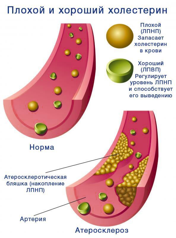 Холестерин плохой и хороший - опасность и норма у женщин