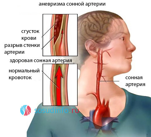 Бифуркация - это раздвоение трахеи, аорты или сонной артерии