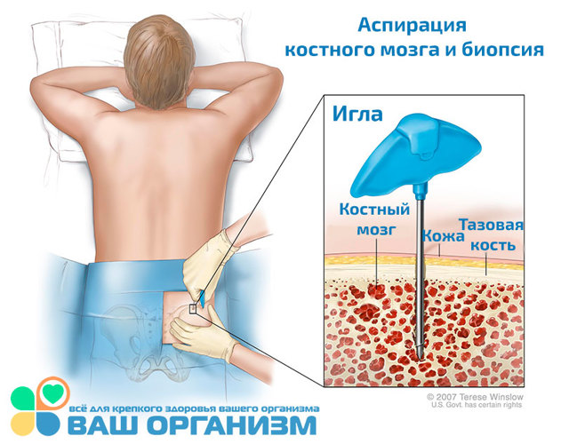 Лейкоз - злокачественное заболевание крови