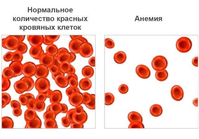Как повысить гемоглобин в домашних условиях без таблеток