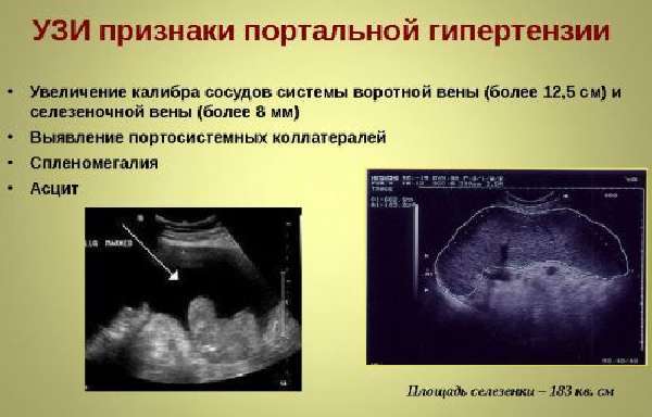 Воротная вена печени 9 мм - Лечение печени