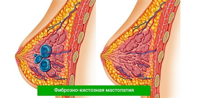 Болит посередине грудной клетки: причины, лечение, диагностика.