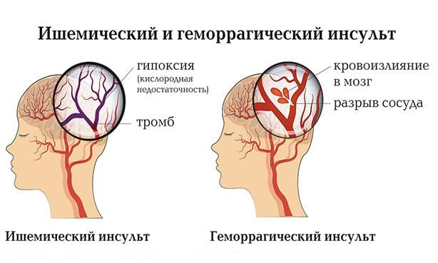 Повторный ишемический инсульт выживаемость - Инсульт
