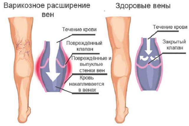 Вены на ногах вылезли что делать - Сайт о варикозе