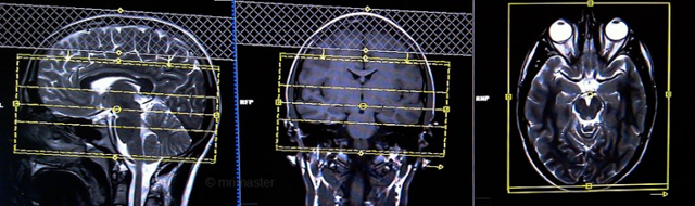 Ангиография (МРА) головного мозга. Личный опыт