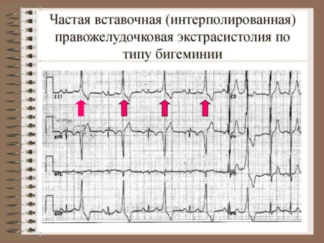 Экстрасистолы по типу бигеминии