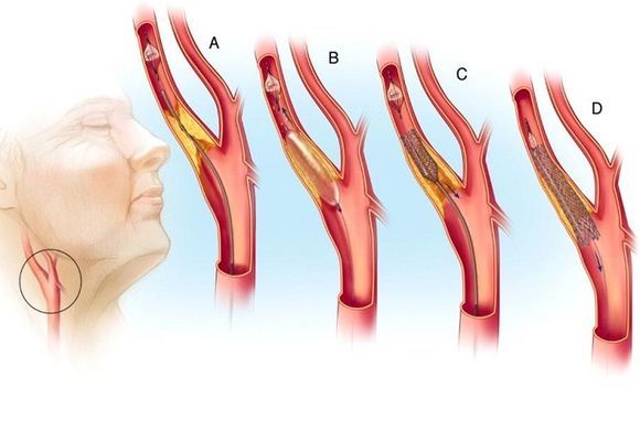 Тромб в сонной артерии: лечение, симптомы и удаление
