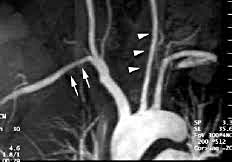 Артериит Такаясу — обследование, диагноз
