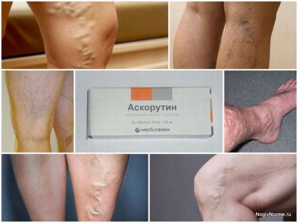 Как принимать Аскорутин для укрепления стенок сосудов: отзывы при профилактике купероза