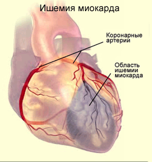 Ишемическая болезнь сердца - причины, симптомы, лечение