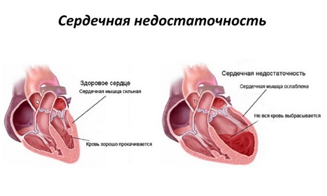 Кашель при сердечной недостаточности - Гипертонии нет