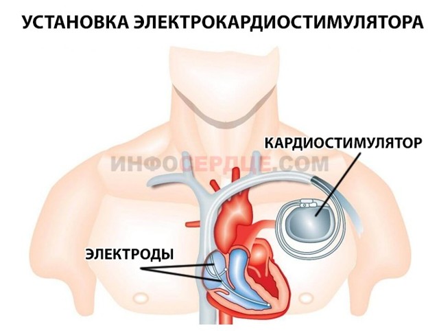 Неполная блокада левой ножки пучка Гиса - причины, лечение