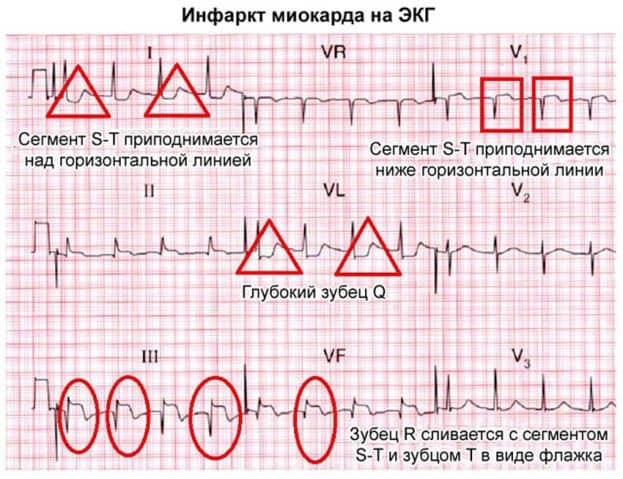 Инфаркт миокарда на ЭКГ: признаки, расшифровка