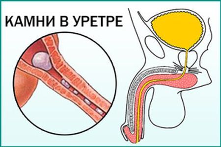 Жжение при мочеиспускании у мужчин - причины