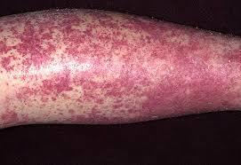 Васкулит на ногах - что это такое и как лечить?