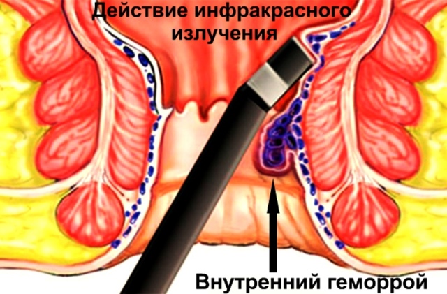 Геморрой при беременности - признаки, симптомы, причины и лечение