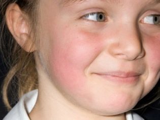 Эритема у детей и взрослых: симптомы, фото, лечение