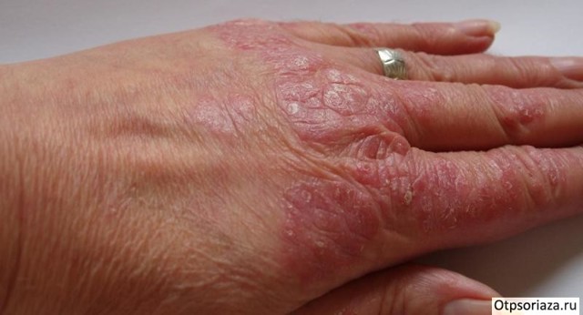 Лечение псориаз на руках - фото, симптомы, виды псориаза на руках