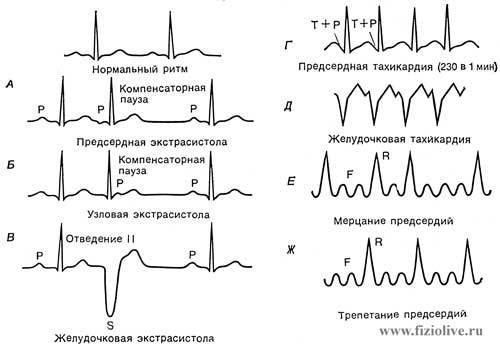 Картинки ЭКГ при нарушениях ритма