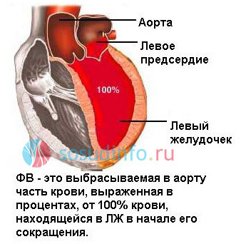 Причины снижения фракции выброса левого желудочка. Причины сердечной недостаточности со сниженной ФВ