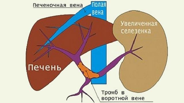 Воротная вена печени 9 мм - Лечение печени