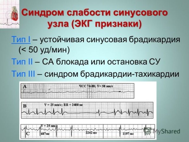 Синусовый ритм: что это в заключении ЭКГ, расшифровка и норма