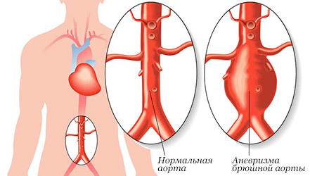 Питание при аневризма брюшной аорты -