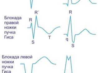 Неполная блокада правой ножки пучка Гиса