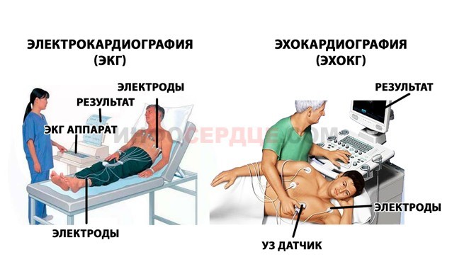 Перегрузка правого предсердия причины - Все про гипертонию