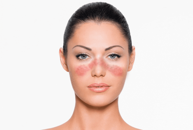 Волчанка - причины, признаки и симптомы, лечение