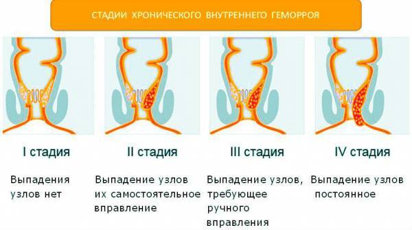Выпал геморроидальный узел