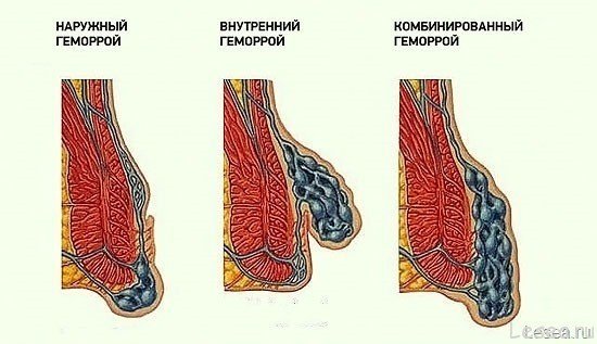 Геморрагический васкулит реферат