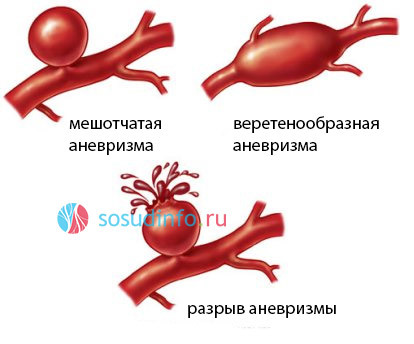Бифуркация - это раздвоение трахеи, аорты или сонной артерии