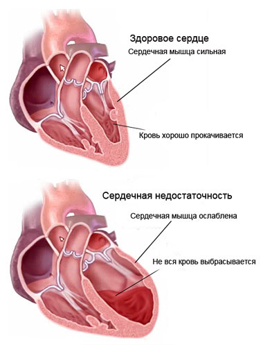 Застой в легких при сердечной недостаточности