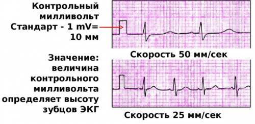 Как делают ЭКГ: техника наложения и снятия электродов, как снимают и накладывают
