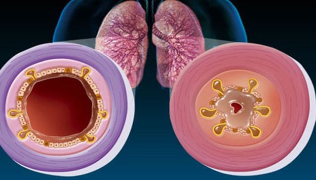 Бронхит при беременности, чем и как производить лечение у беременных на 1,2,3 триместре. Можно ли антибиотики на ранних сроках и последствия заболевания на начальных сроках беременности