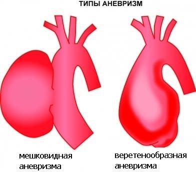 Питание при аневризма брюшной аорты -