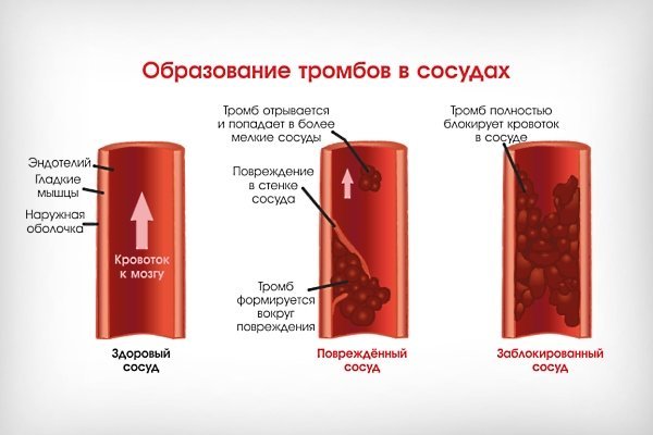 Рассасывается ли тромбоз глубоких вен