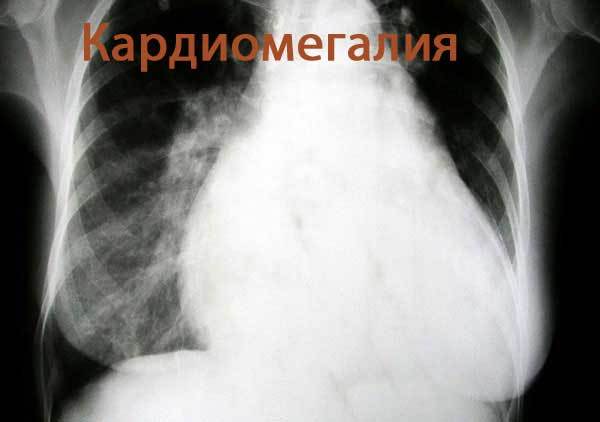 Заболевание бычье сердце