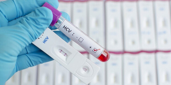 Вирус гепатита С (Hepatitis C Virus), качественное суммарное определение антител, ИФА (anti-HCV, кач.)