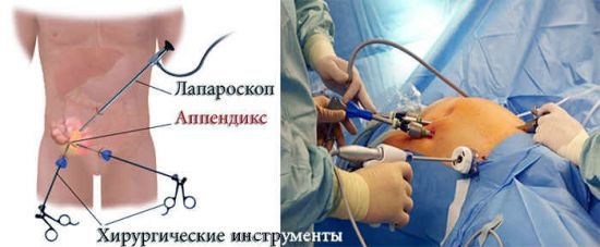 Острый аппендицит у взрослых