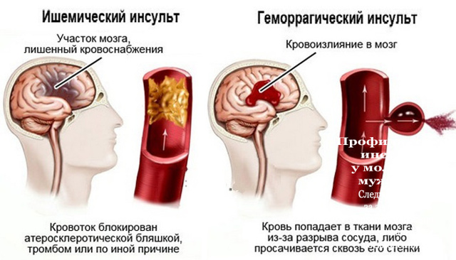 Критические дни после инсульта
