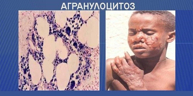 Болезнь крови. Болезни органов крови