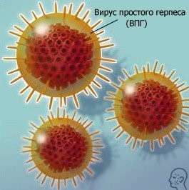 Герпес на губах - причины, признаки, симптомы, лечение