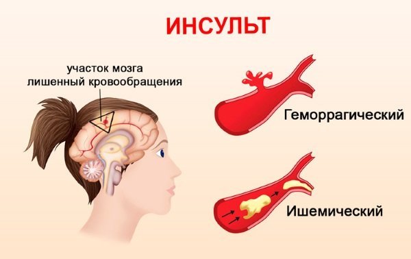 Восстановление руки после инсульта в домашних условиях