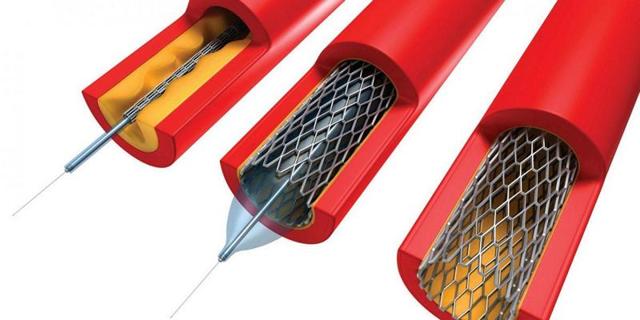 От чего происходит инфаркт миокарда