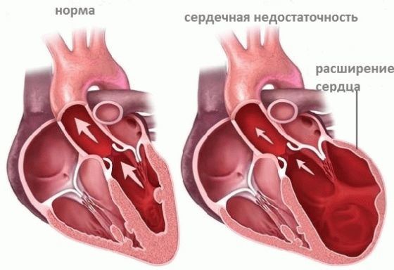Узлы в прямой кишке - Геморроидальные узлы