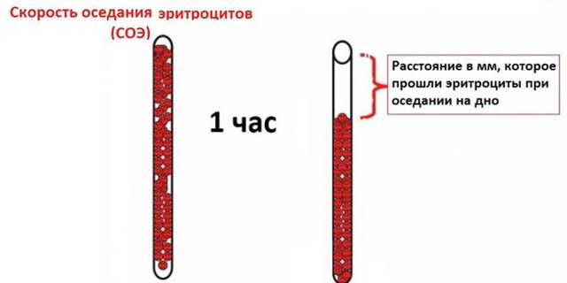 СОЭ анализ крови: норма и возможные отклонения
