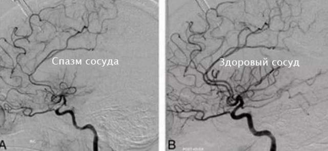 Спазмы сосудов головного мозга: симптомы, лечение, препараты, профилактика
